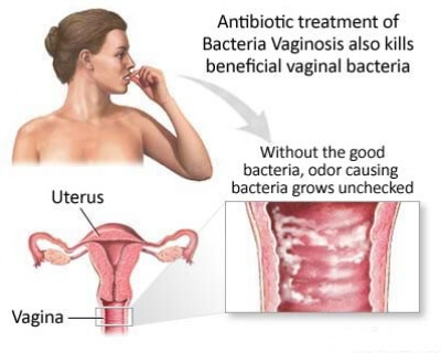 Bacterial Infection vaginosis