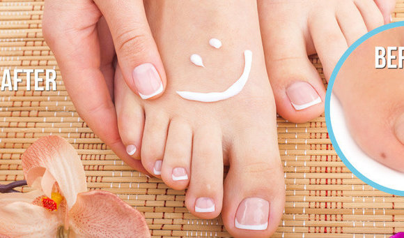 Top 4 Remedies To Treat Toe Nail Fungus Naturally