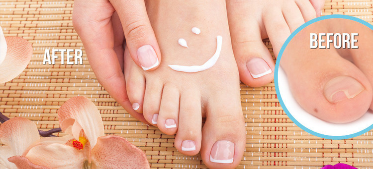 Top 4 Remedies To Treat Toe Nail Fungus Naturally